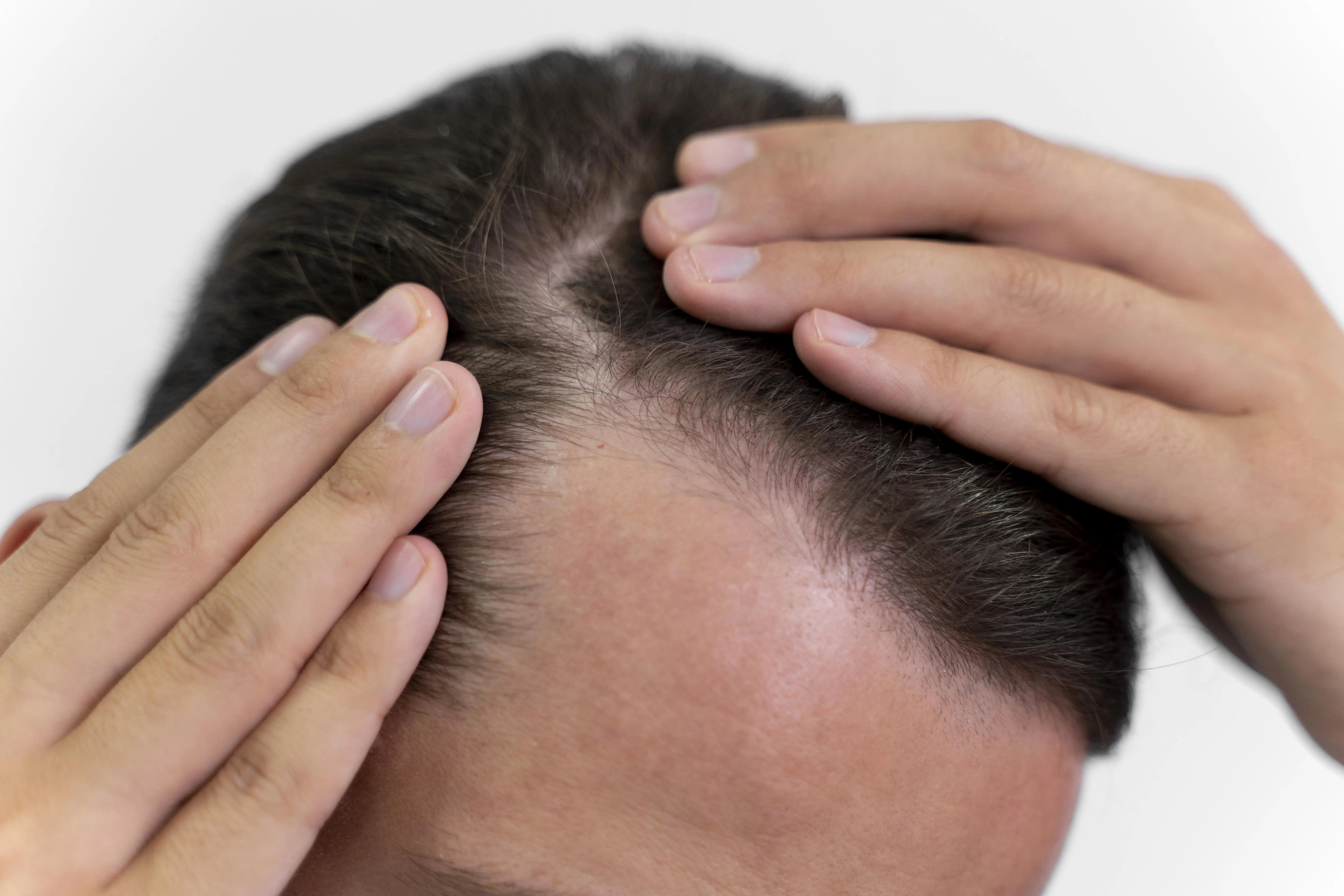 Calvície masculina: cortes e truques para disfarçar a queda